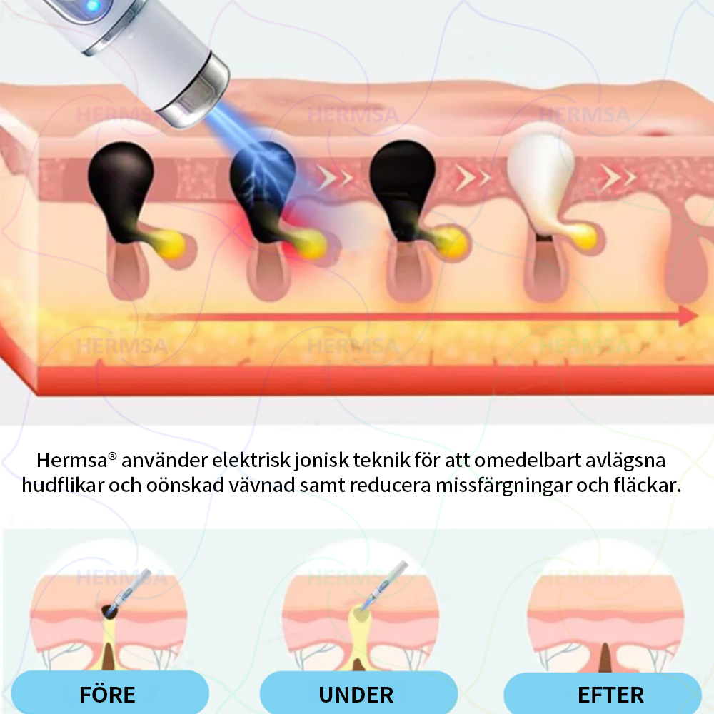 Hermsa® ikke-invasiv laserskaler - fjerning av bein og vorter (🔥Siste dag 80% rabatt)