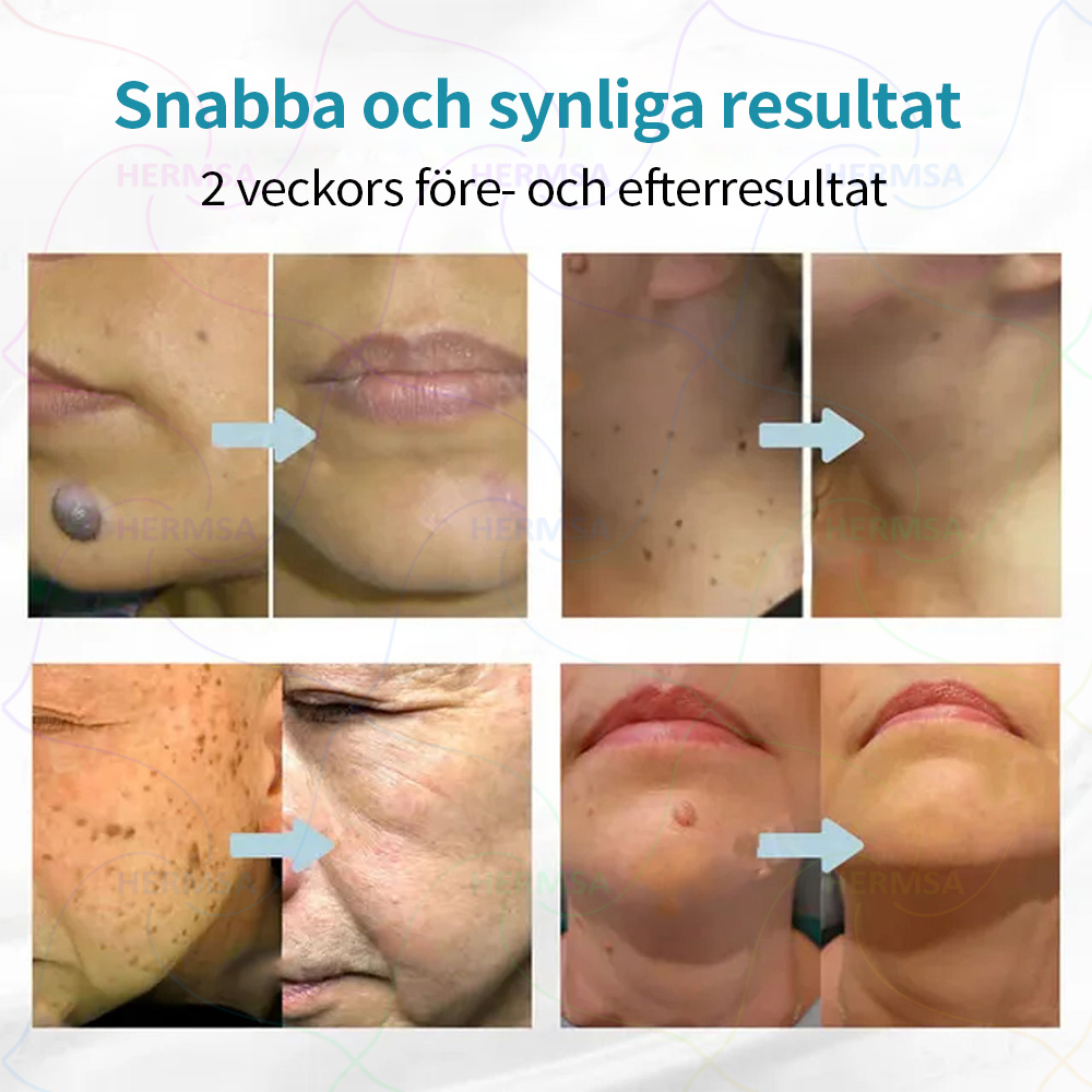 Hermsa® ikke-invasiv laserskaler - fjerning av bein og vorter (🔥Siste dag 80% rabatt)